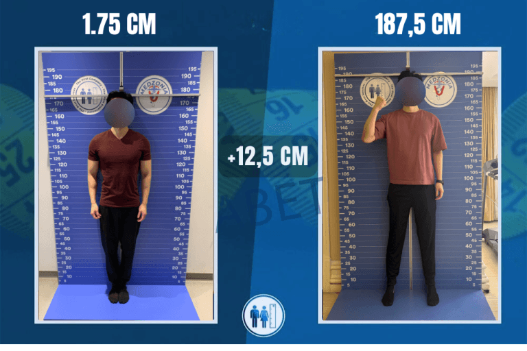 limb-lengthening-surgery-before-after