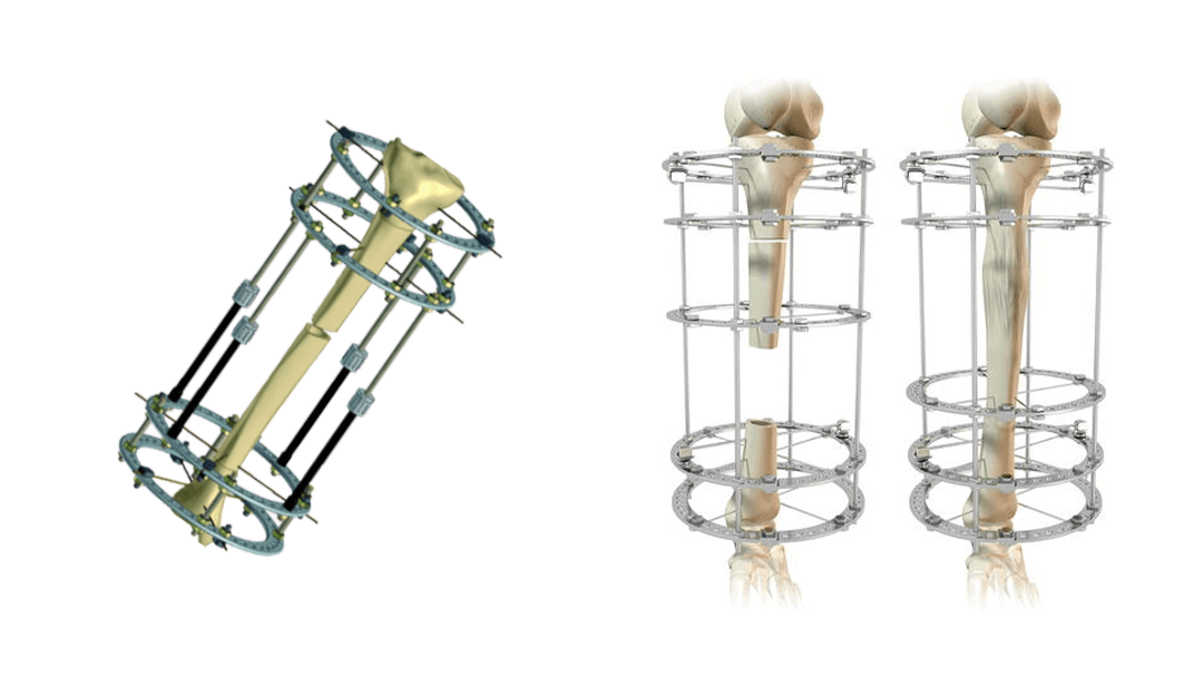 Evolution of limb lenghtening surgery