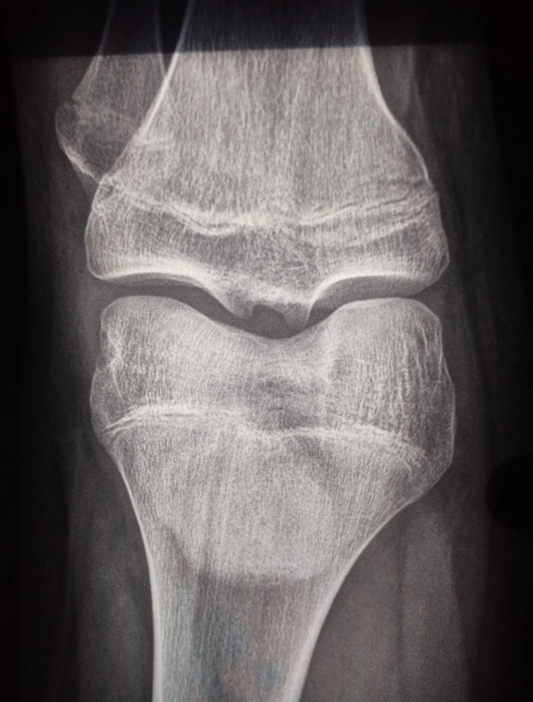 Growth Plates When Do Growth Plates Close Leg Lengthening