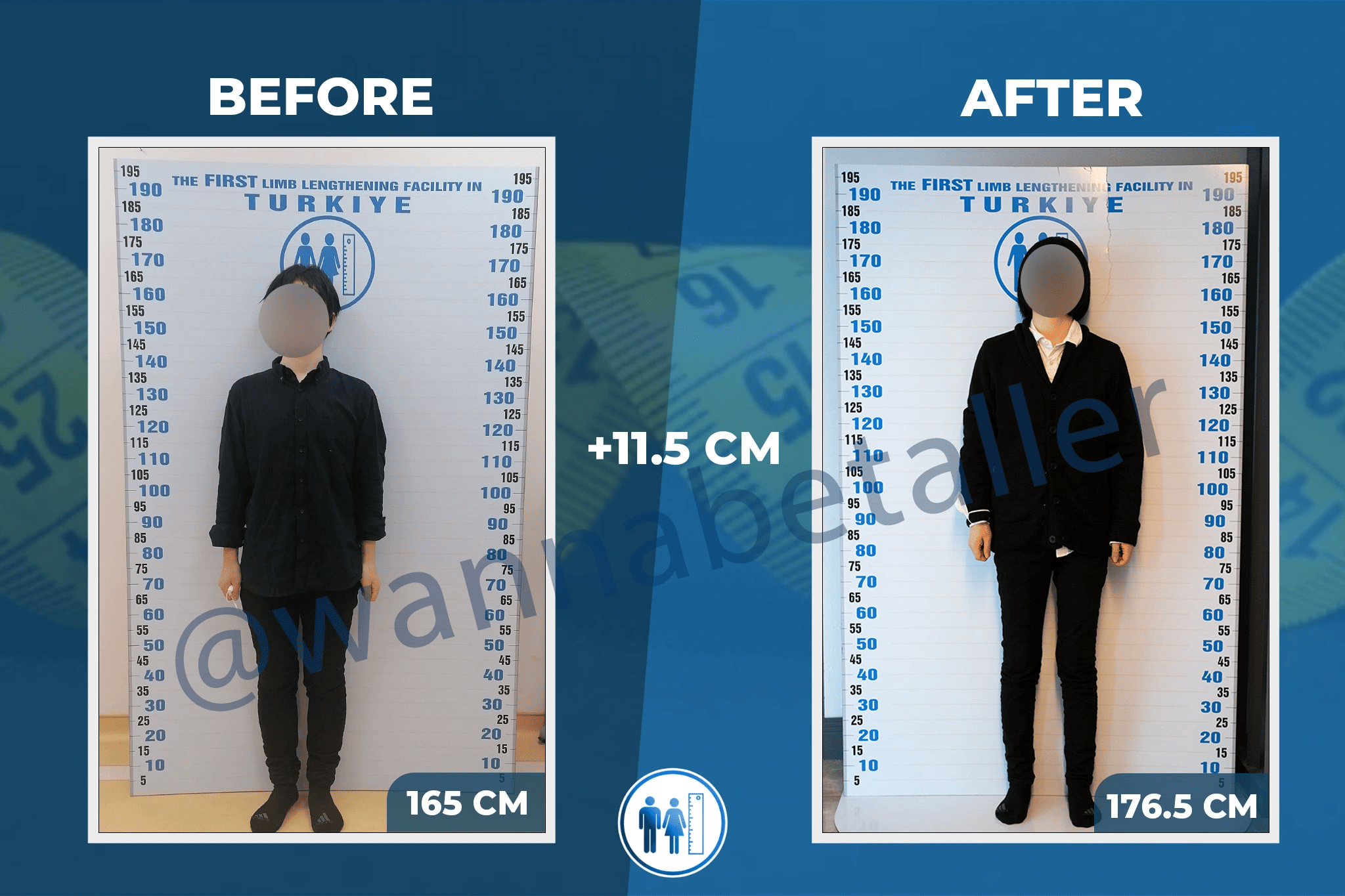 Limb lengthening surgery - patient's before-after picture