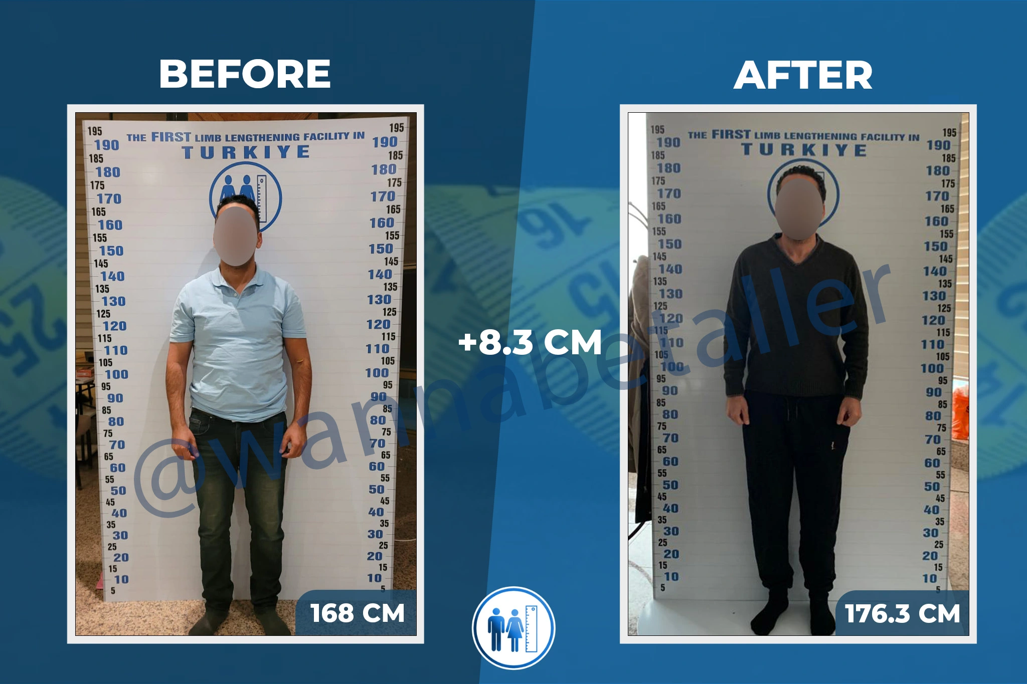 limb-lengthening-surgery-before-after-15 (2)