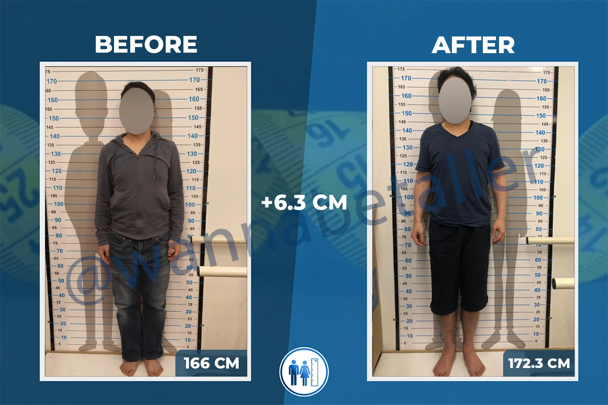 limb-lengthening-surgery-before-after-9 (1)