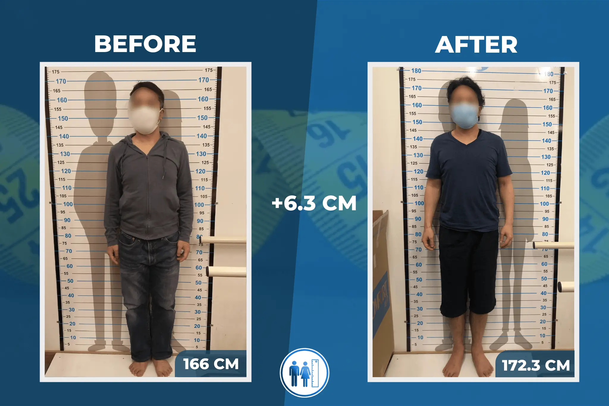 limb-lengthening-surgery-before-after-9